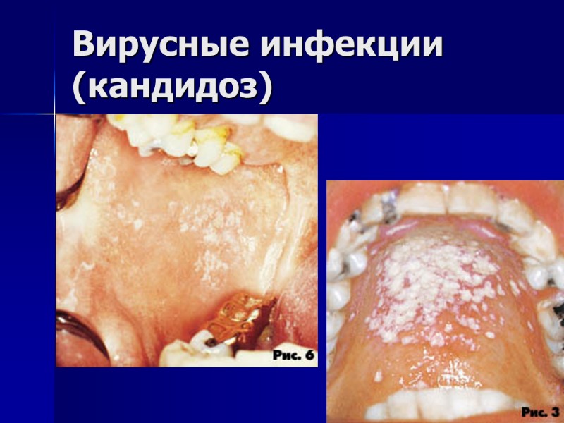 Вирусные инфекции (кандидоз)